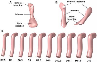 Hourglass-shaped grafts are superior to conventional grafts for restoring knee stability and graft force at knee flexion angle of 30° following anterior cruciate ligament reconstruction: A finite element analysis